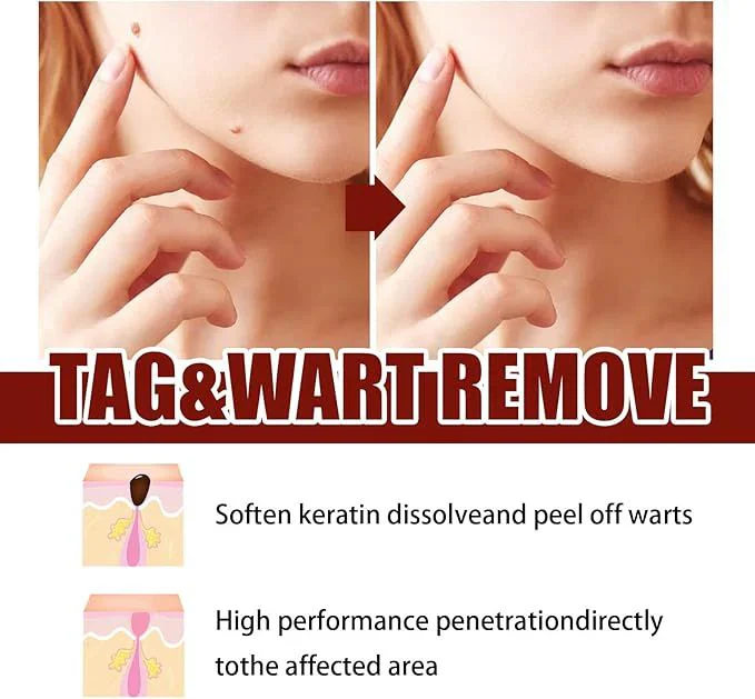 Jaysuing Liquid Wart Flat – Advanced Wart Remover for Face, Hands & Body (20ml)