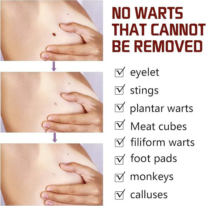 Jaysuing Liquid Wart Flat – Advanced Wart Remover for Face, Hands & Body (20ml)