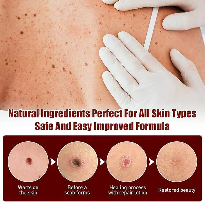 Jaysuing Liquid Wart Flat – Advanced Wart Remover for Face, Hands & Body (20ml)